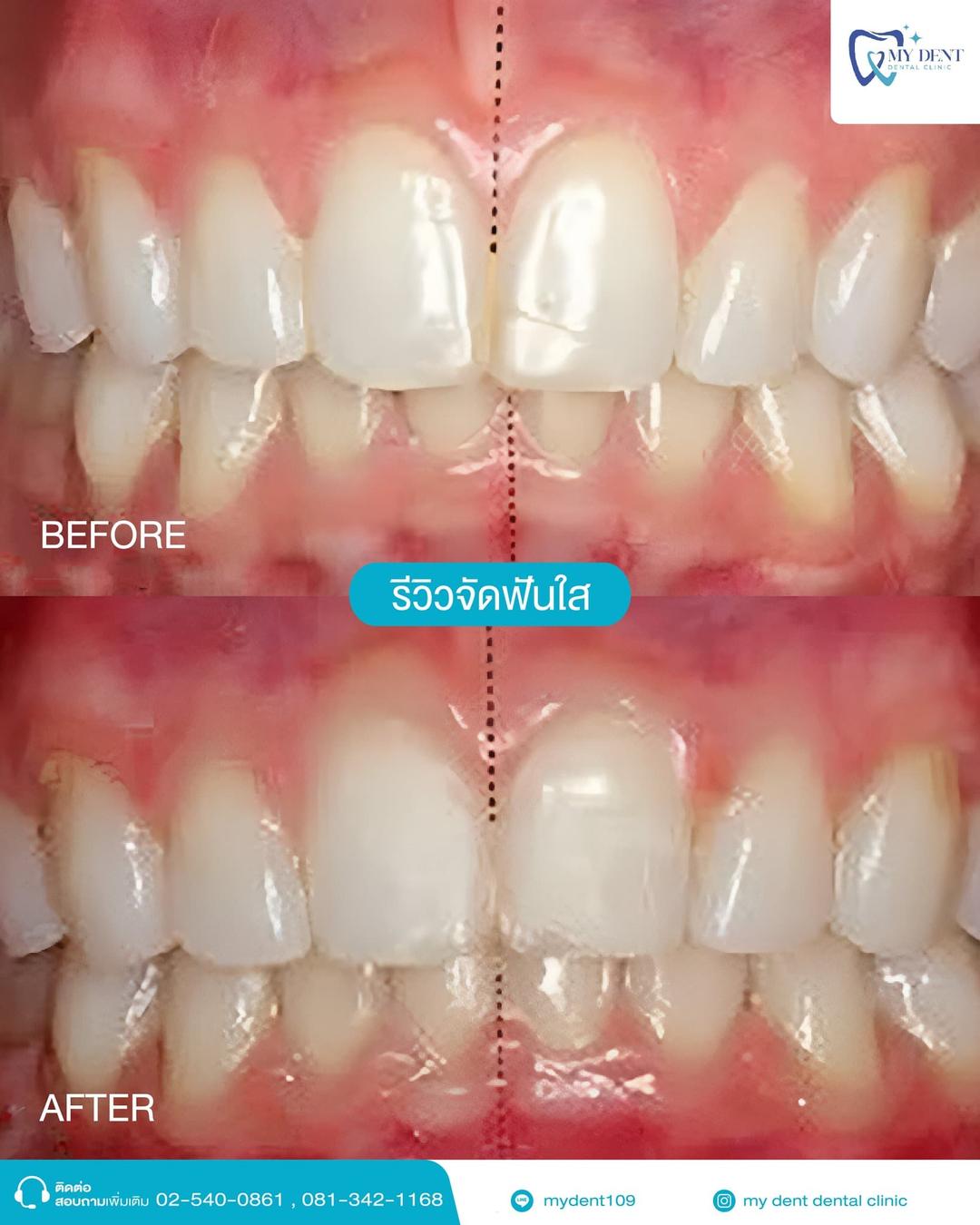 จัดฟัน จัดฟันใส รักษารากฟันโดยทันตแพทย์เฉพาะทาง